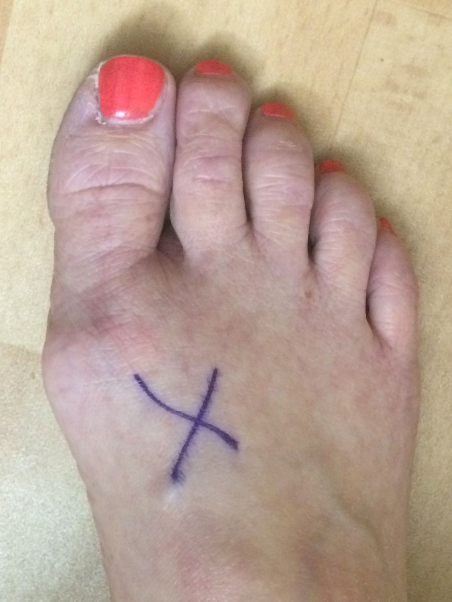 Bunion before